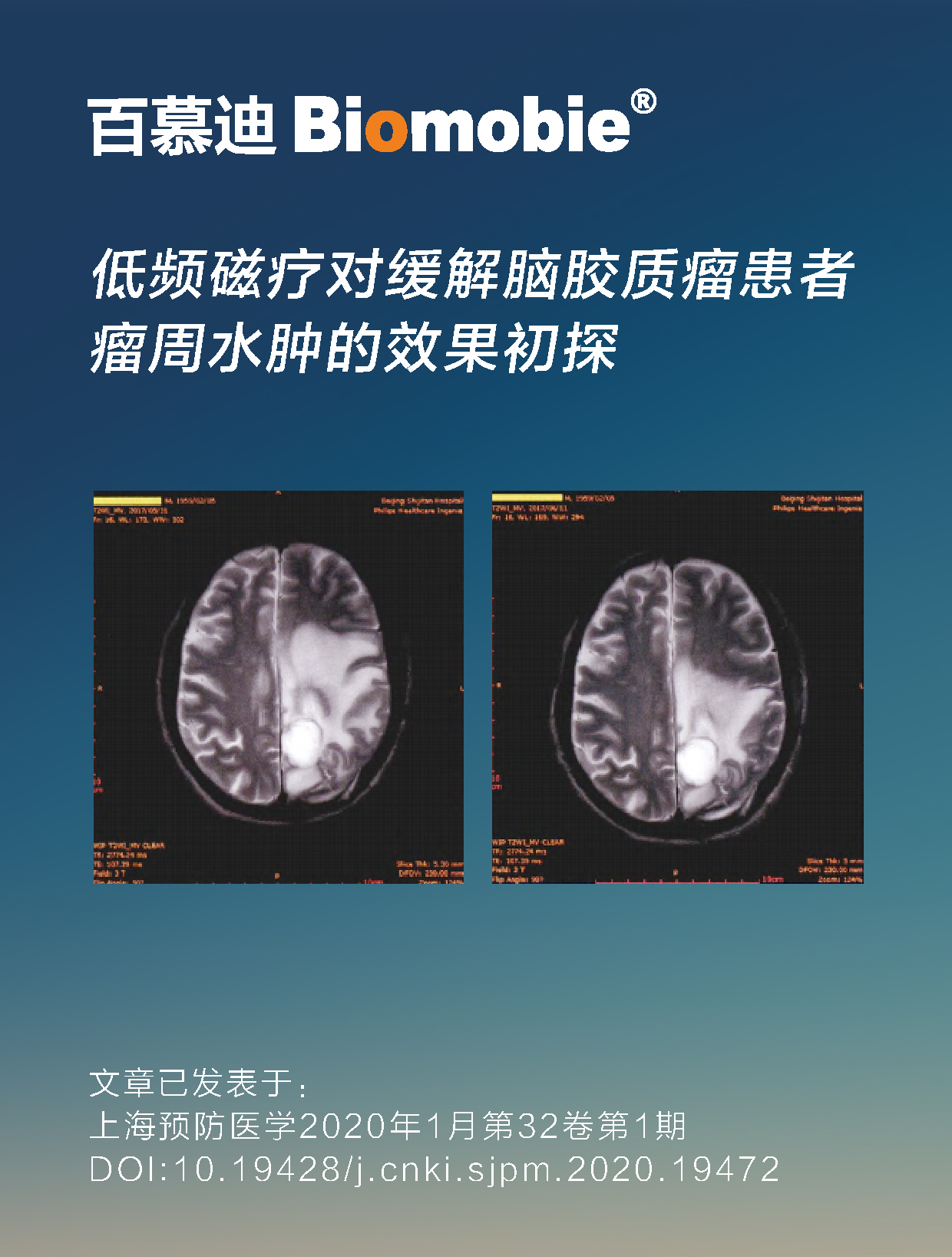 脑胶质瘤 中.pic.jpg
